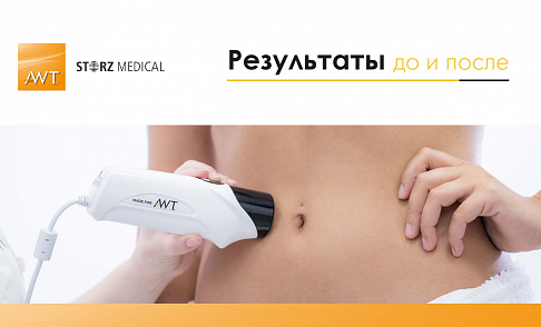 Результаты AWT Storz Medical